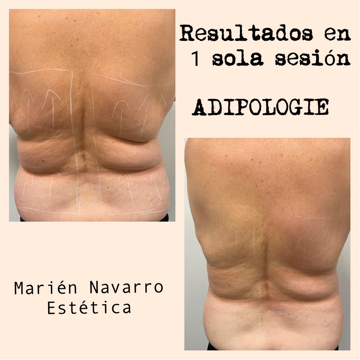 Resultado tratamiento Adipologie Marién Navarro Estética